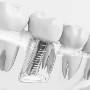 Dental Implants